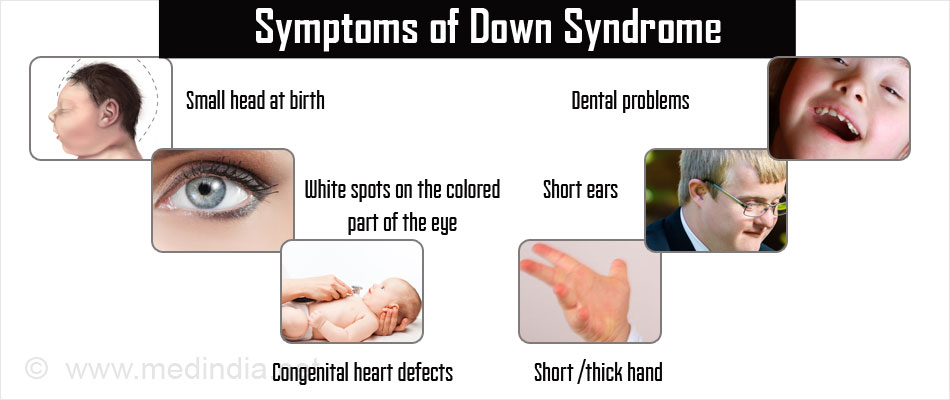 Down Syndrome: Causes, Types, and Symptoms