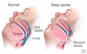 Obstructive sleep apnea