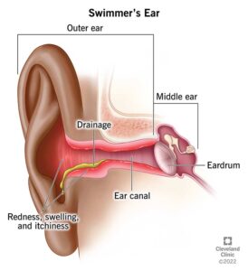 Diagnoses and Examinations How can medical professionals identify swimmer's ear? A medical professional will check your ears for swelling, redness, or other damage indicators. Your healthcare professional could remove a sample of the discharge from your ears in order to identify the source of the illness. Different treatments are needed for fungal and bacterial infections. 