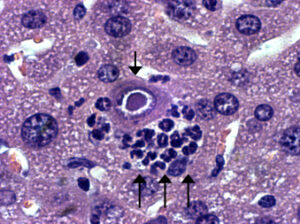 Cytomegalovirus (CMV) infection