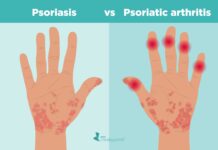 One kind of arthritis is psoriatic arthritis. People with psoriasis or those with a biological family history of the condition are typically affected.