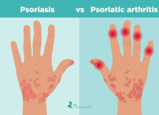 One kind of arthritis is psoriatic arthritis. People with psoriasis or those with a biological family history of the condition are typically affected.