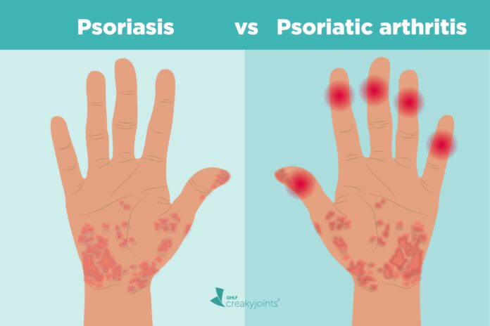 One kind of arthritis is psoriatic arthritis. People with psoriasis or those with a biological family history of the condition are typically affected.