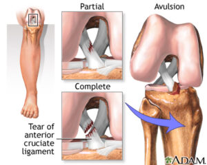 Anterior Cruciate Ligament Injury (ACL Injury) 