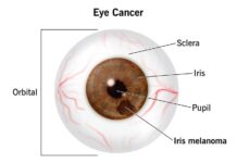 Cancer of the Eyes