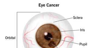 Cancer of the Eyes