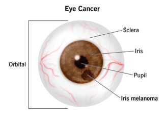 Cancer of the Eyes