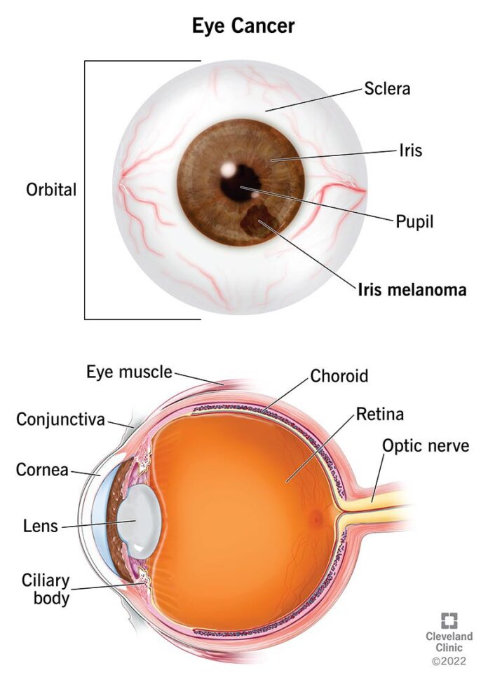 Cancer of the Eyes