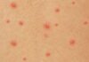 Chickenpox