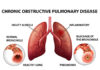 Diseases of the Lungs