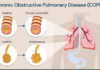 chronic obstructive pulmonary disease (copd)