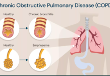 chronic obstructive pulmonary disease (copd)