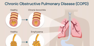 chronic obstructive pulmonary disease (copd)