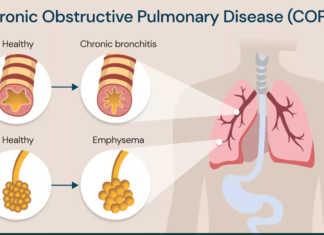 chronic obstructive pulmonary disease (copd)