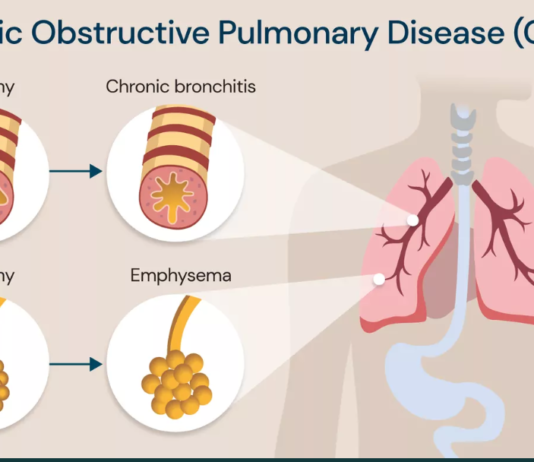 chronic obstructive pulmonary disease (copd)