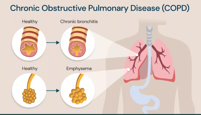 chronic obstructive pulmonary disease (copd)