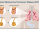 chronic obstructive pulmonary disease (copd)