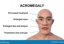 ACROMEGALY