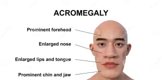 ACROMEGALY