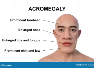 ACROMEGALY