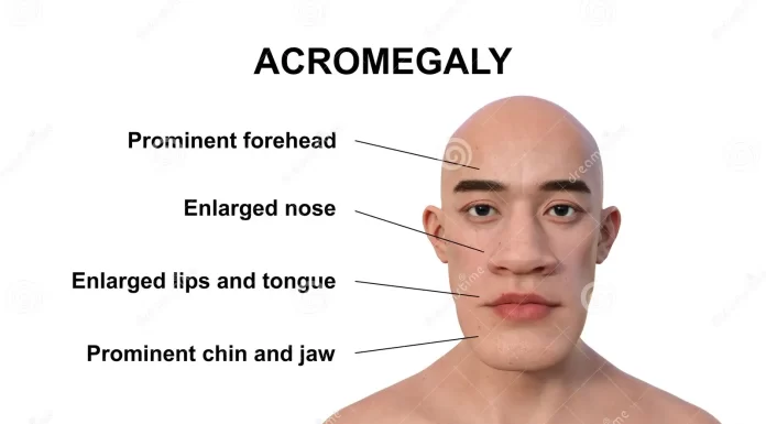 ACROMEGALY