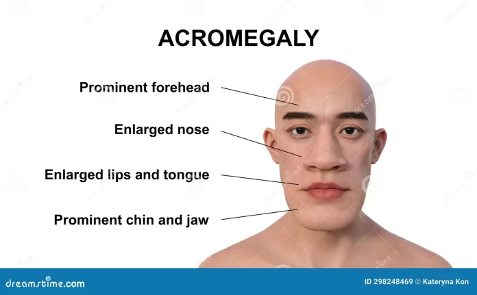 ACROMEGALY