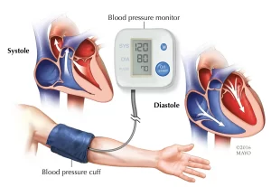 Hypertension