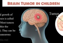 Brain tumors in children