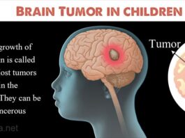 Brain tumors in children