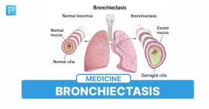 Bronchiectasis