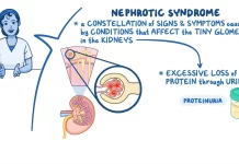 Nephrotic Syndrome