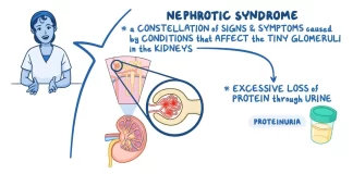 Nephrotic Syndrome