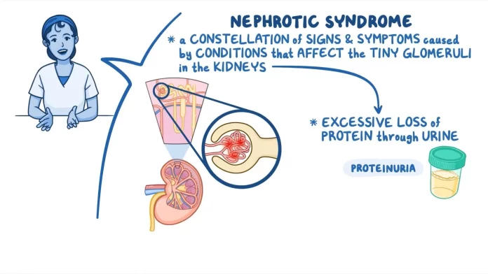 Nephrotic Syndrome