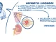 Nephrotic Syndrome